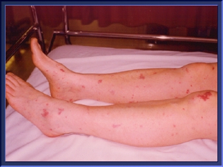 mm-rash-leg-early.jpg (55661 bytes)
