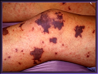 mm-rash-leg.jpg (71188 bytes)